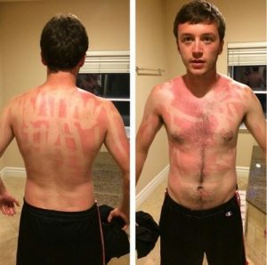 16 Horribly Hilarious Sunburns That Will Make You Want To Slather On The SPF