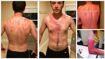 16 Horribly Hilarious Sunburns That Will Make You Want To Slather On The SPF
