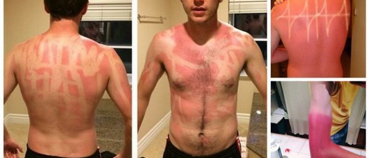 16 Horribly Hilarious Sunburns That Will Make You Want To Slather On The SPF