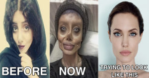 This Iranian Teen Undergoes 50+ Surgeries In Hope To Look Like Angelina Jolie