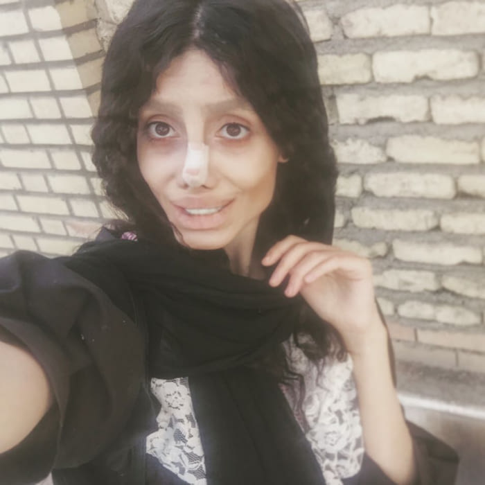 This Iranian Teen Undergoes 50 Surgeries In Hope To L