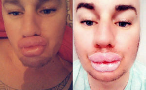 Man Pays Thousands & Undergoes 25+ Surgeries In Hope To Look Like Marilyn Monroe