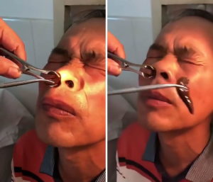 Doctor In China Removes A Huge Leech That's Alive From Patient's Nostril