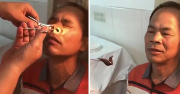 Doctor In China Removes A Huge Leech That's Alive From Patient's Nostril
