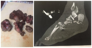 This Guy Served His Friends Tacos Made From His Own Amputated Leg