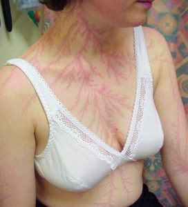 These People Survived Getting Struck By Lightning Show What It Does To Your Skin