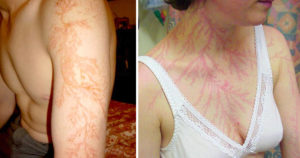 These People Survived Getting Struck By Lightning Show What It Does To Your Skin