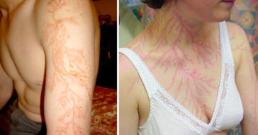 These People Survived Getting Struck By Lightning Show What It Does To Your Skin