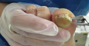 Pus Leaks Out Of Fungal Toenail As Woman Rips It Straight Off