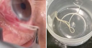 Watch This Doctor Remove 15cm Long Wiggly Parasitic Worm From Man's Eye