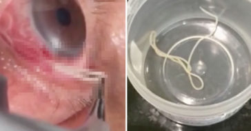 Watch This Doctor Remove 15cm Long Wiggly Parasitic Worm From Man's Eye