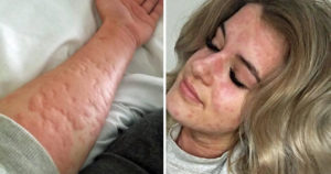 This Woman Allergic To Winter Cold Could Die If She Doesn't Wrap Up Warm