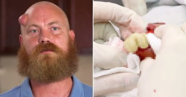 Dr Pimple Popper Squeezes Cheesy Grit Out Of A Man's Golf Ball Size Head Cyst