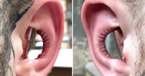 Man Has Inside of His Ears Taken Out