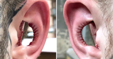 Man Has Inside of His Ears Taken Out